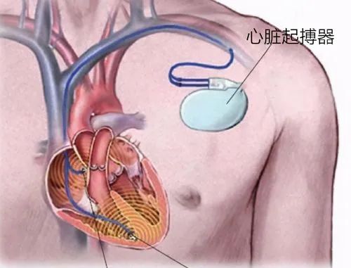 政策解读 | 进口心脏起搏器有哪些监管要求？